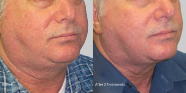 Laser skin tightening