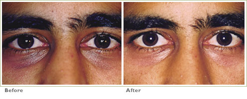 Genesis for Dark circles