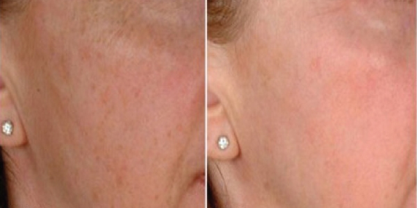 Microneedling-Pigmentation-