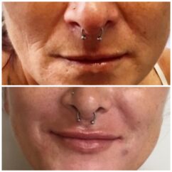 dermal filler los angeles