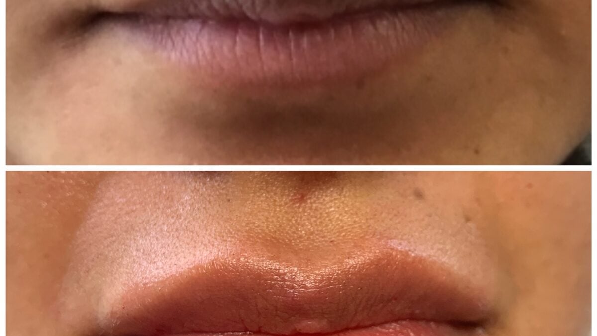 Lip Filler Redondo Beach