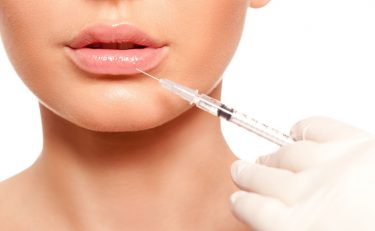 dermal filler for lip augmentation