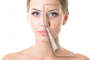 active-acne-concerns