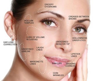 Revanesse Versa facial Filler