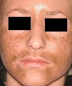 melasma-2